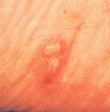 水虫の症状について クラモト皮膚科